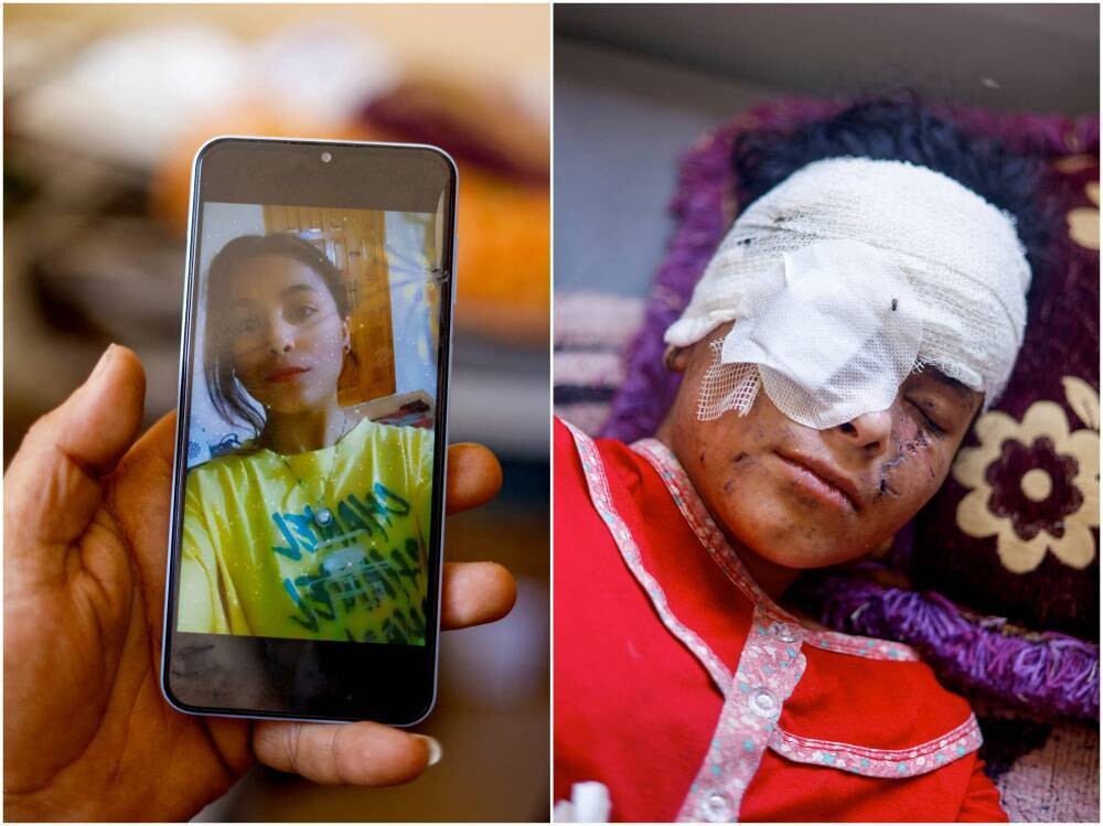 Трагическая история потери зрения подростка из Газа